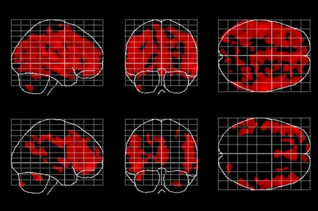 Aging Action Initiative Forever young: Meditation might slow the age-related loss of gray matter in the brain, say UCLA researchers  